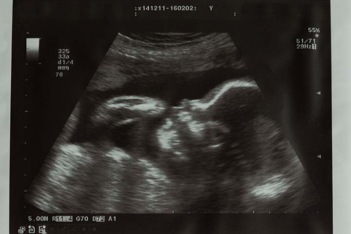胎儿的超声波扫描