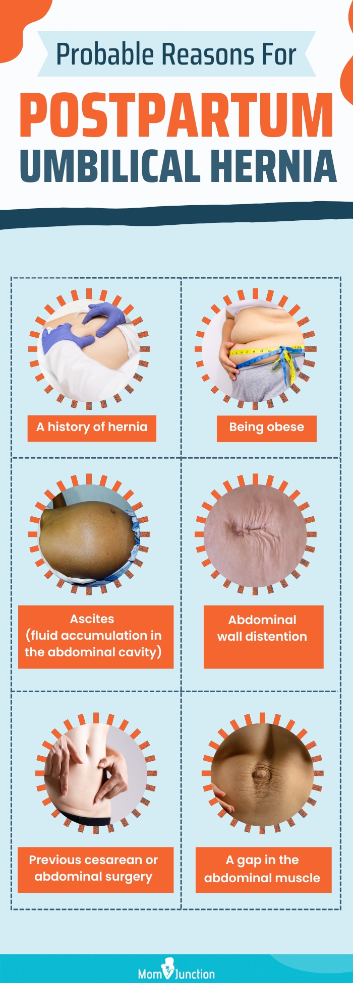 probable reasons for postpartum umbilical hernia (infographic)