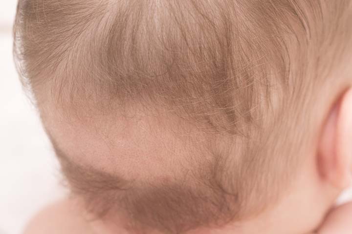 baby bald patch due to hair loss