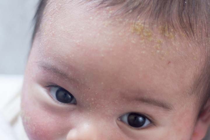 crusty baby scalp requires medical attention