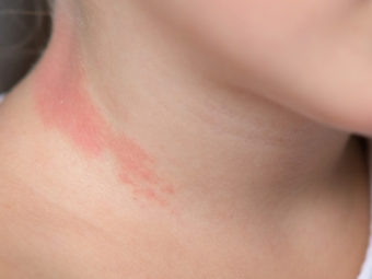 All You Need To Know About Baby Neck Rash