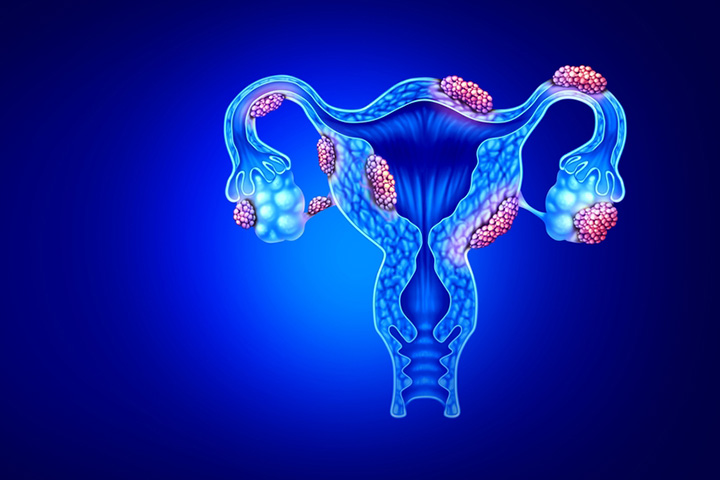 子宫内膜异位症会在卵子周围造成不健康的环境