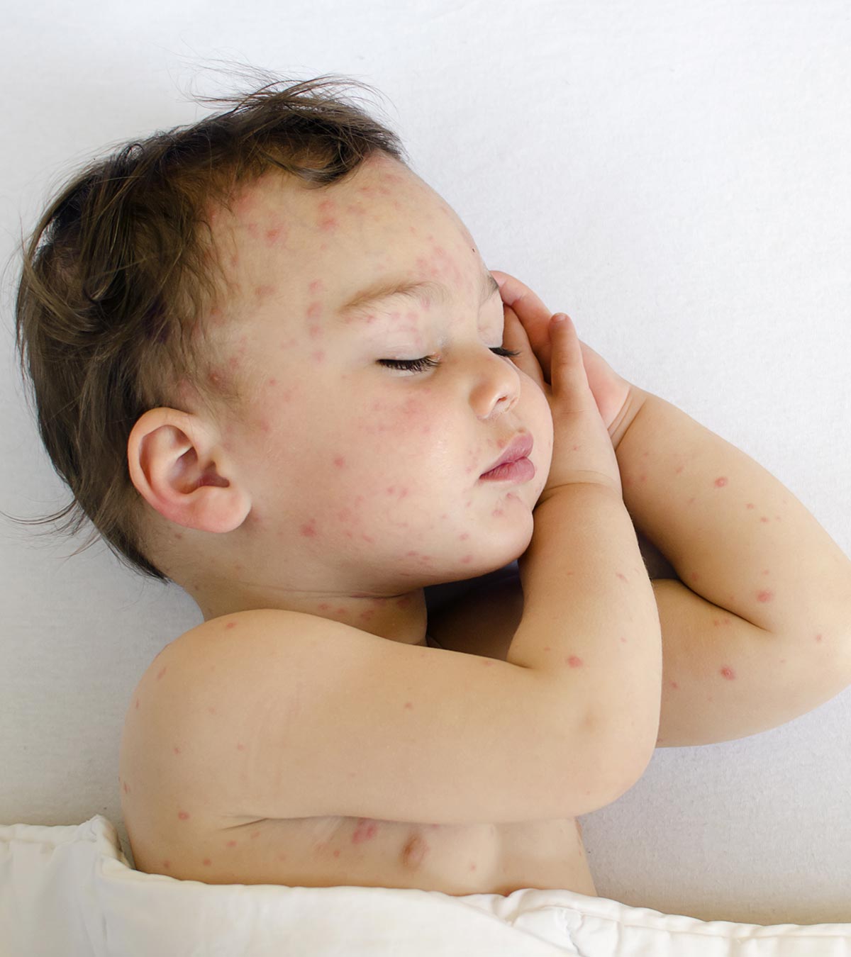 5种安全有效的婴儿蚊虫叮咬治疗方法