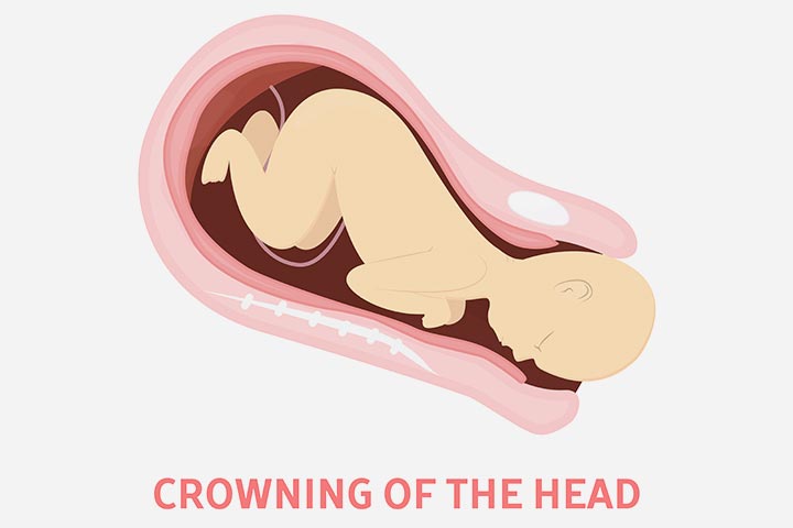 婴儿头冠是指婴儿的头通过阴道露出来