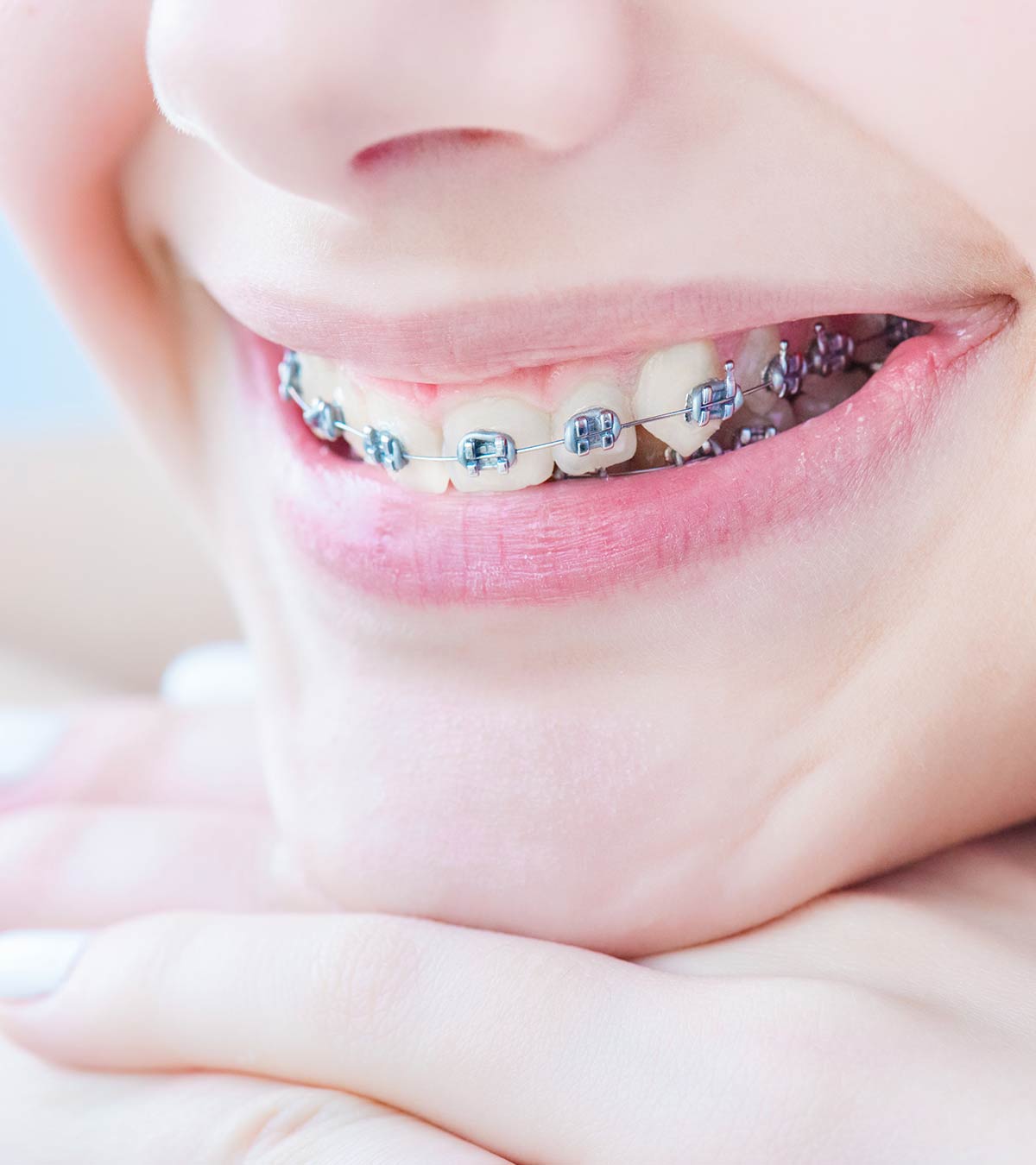 儿童牙套:正确的佩戴年龄和牙科护理