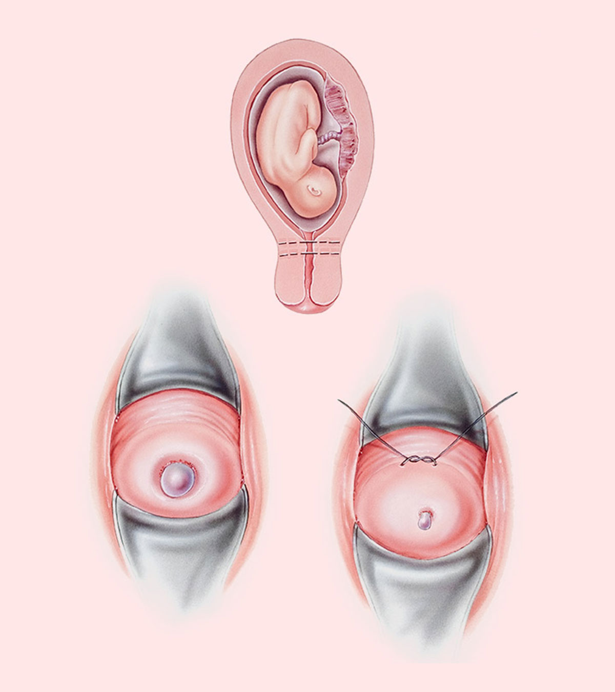 宫颈环扎术:为什么以及如何在怀孕期间进行manbet安卓版