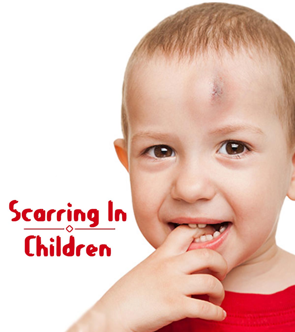 8种治疗儿童疤痕的方法和预防技巧
