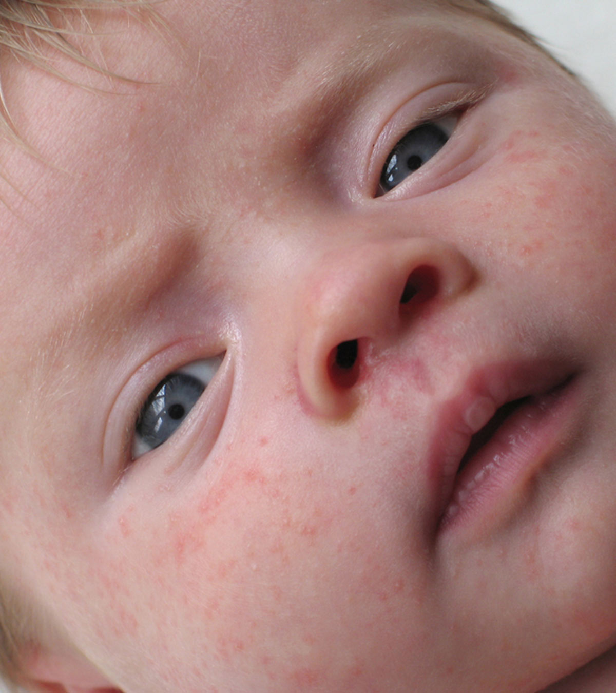 婴儿皮肤过敏的5种类型，治疗和预防