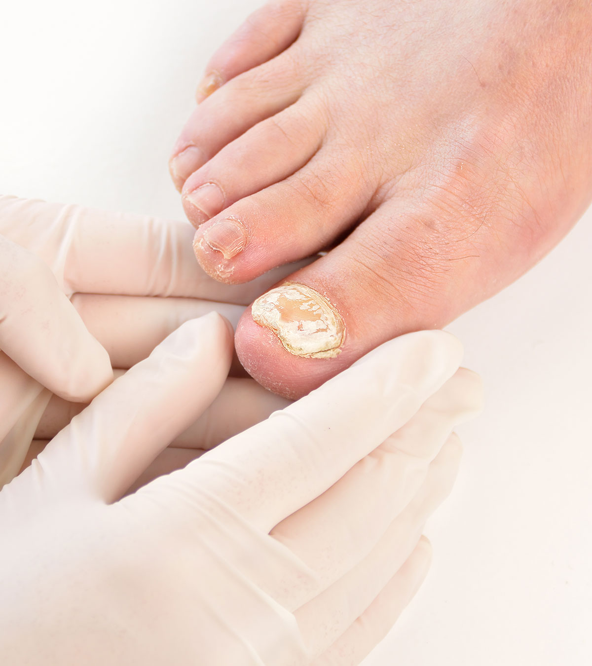 怀孕期间的脚趾甲真菌:自然疗法manbet安卓版和治疗