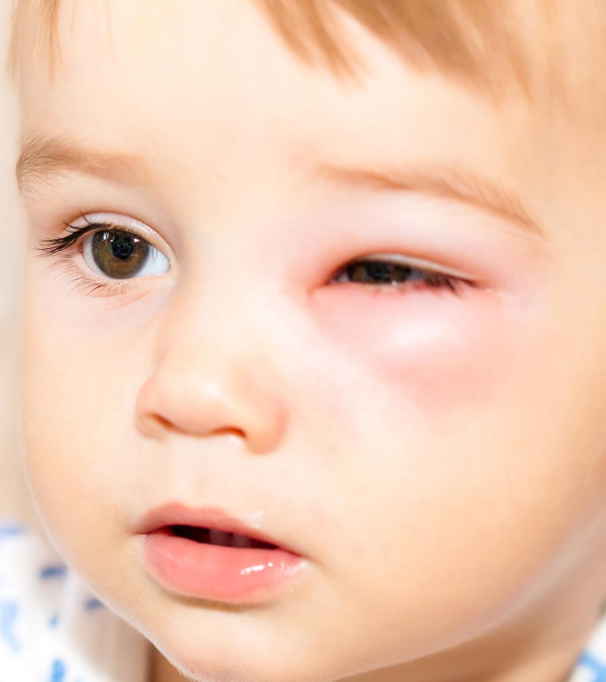 儿童眼眶周围蜂窝织炎的症状和原因