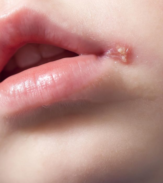 婴儿唇疱疹:原因，风险，治疗和预防