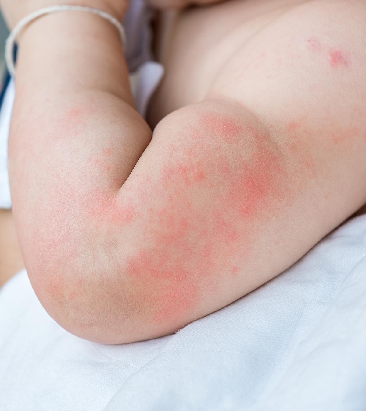 婴儿的荨麻疹:原因、症状、治疗和预防