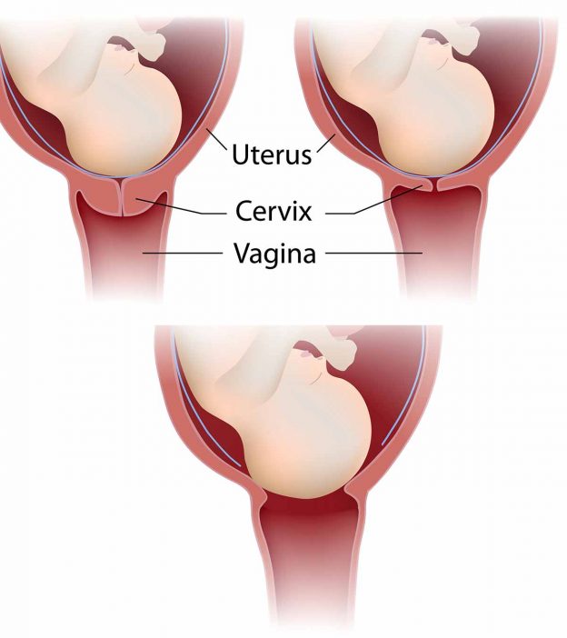 8出生或分娩时子宫颈的变化及其并发症