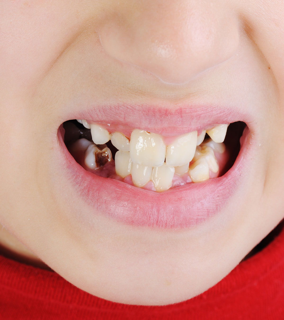 儿童牙齿变色:成因、治疗、补救及预防