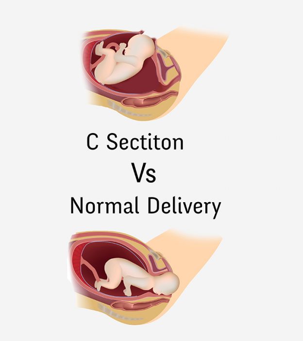 剖腹产与正常分娩:它们有何不同