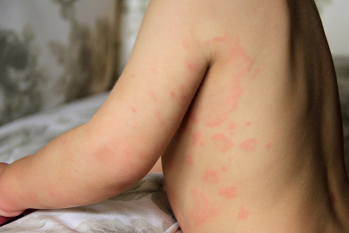 胡萝卜过敏可能会导致婴儿出荨麻疹