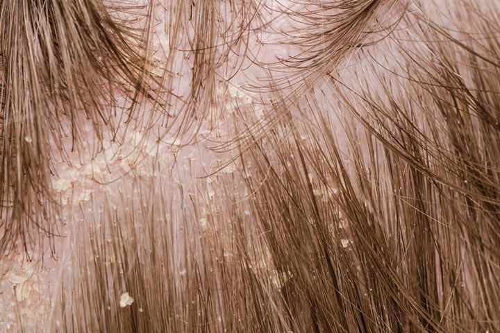 Dry scalp is a symptom of dandruff in kids.