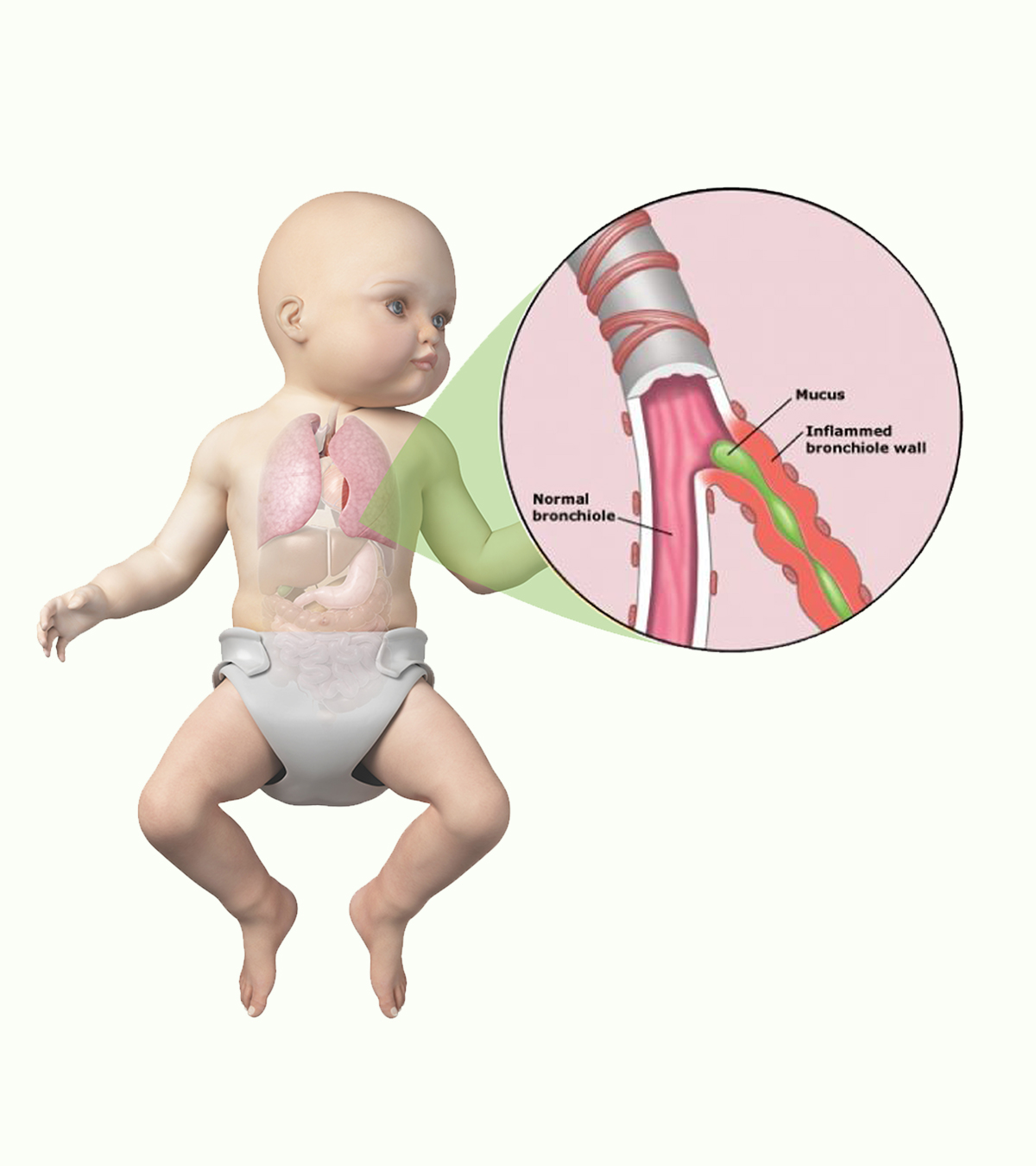 婴儿毛细支气管炎:症状、诊断和治疗