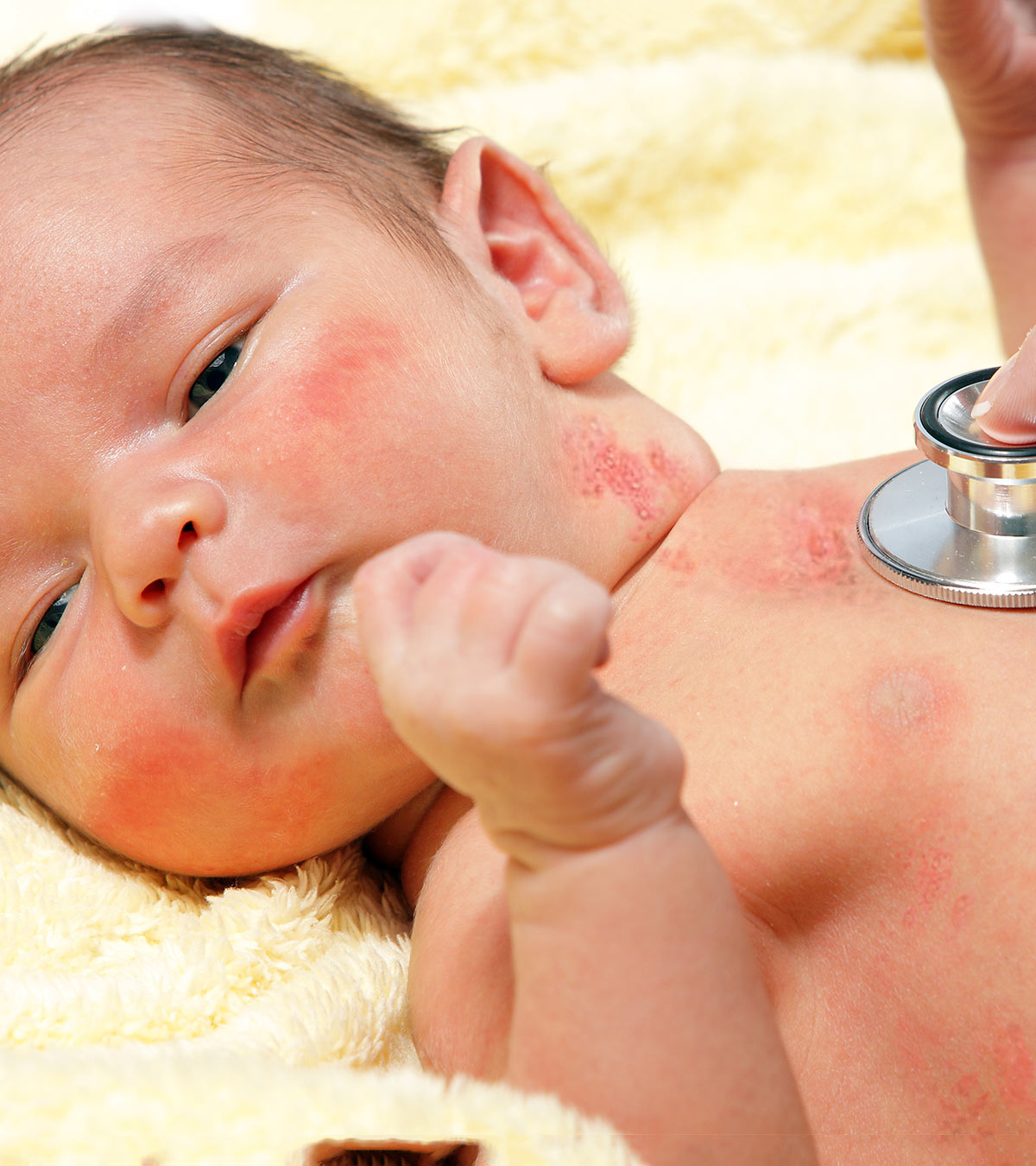 婴儿带状疱疹:症状、原因、诊断和治疗