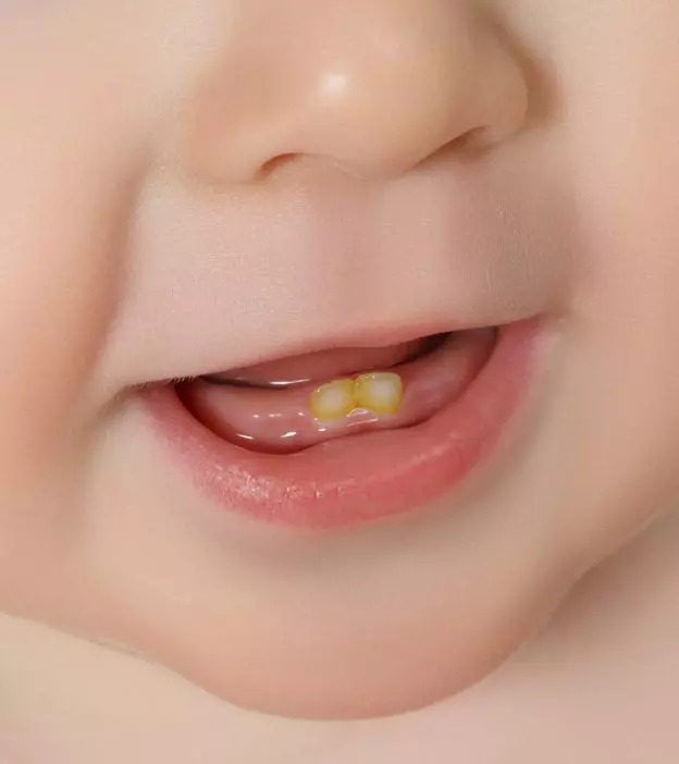 婴儿牙齿变色的7个原因及治疗方法