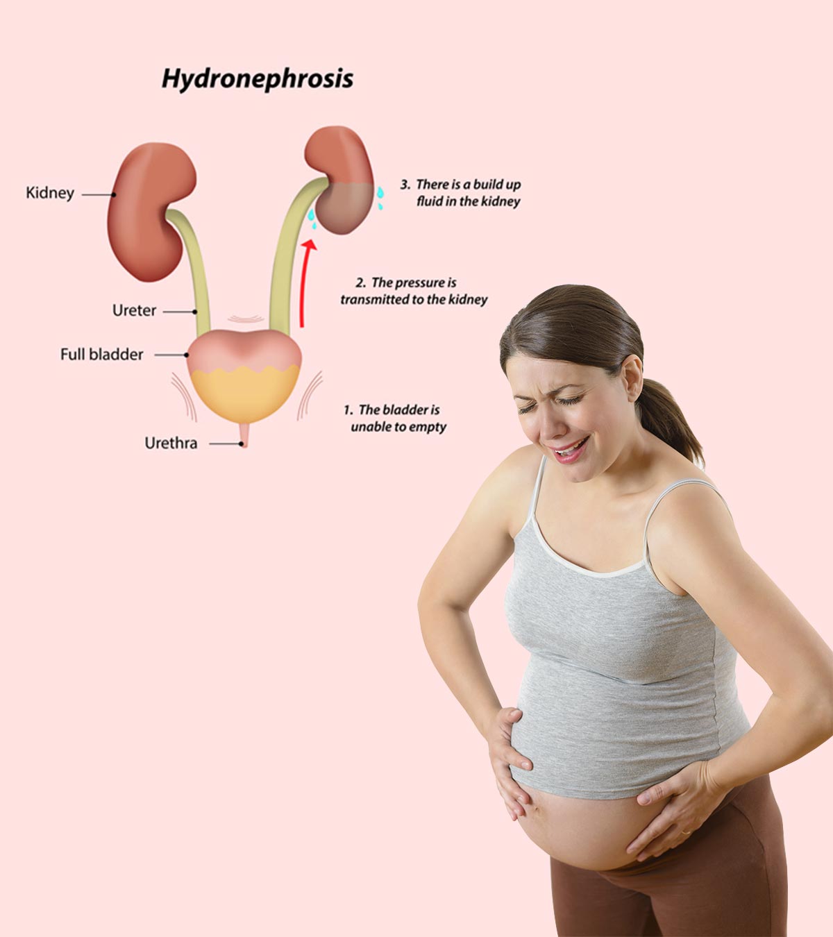 妊娠期肾积水:什么是肾积水，原因及治疗