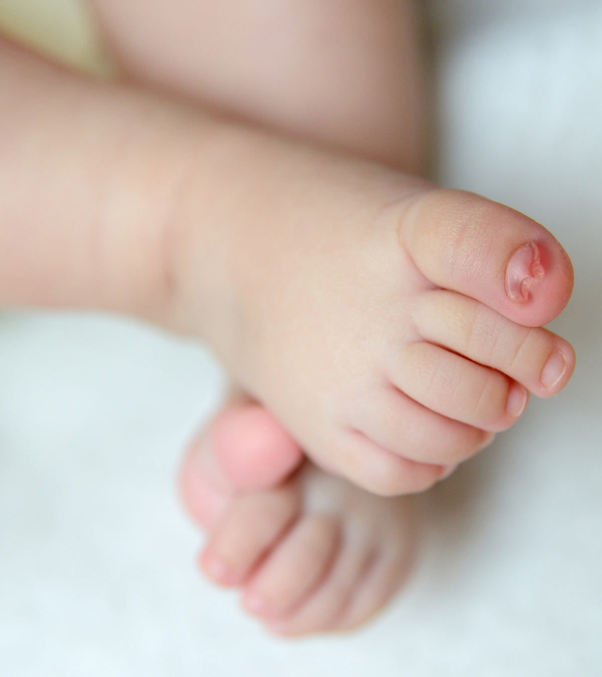 如何治疗和预防婴儿脚趾甲内生?