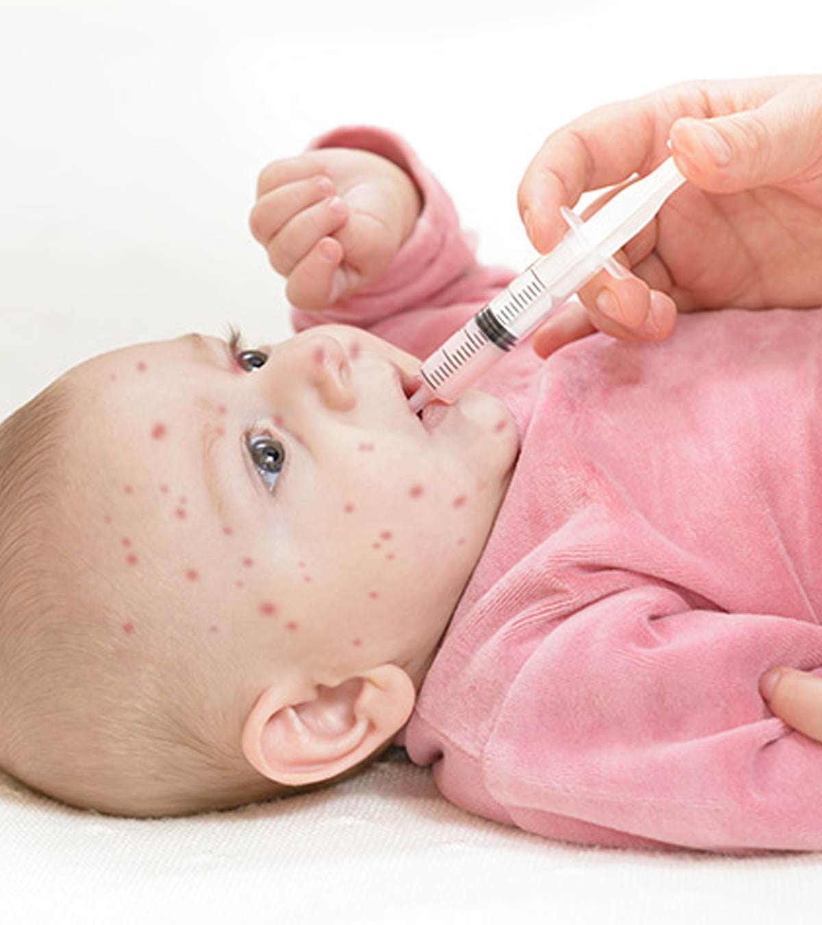 婴儿麻疹:症状、原因和治疗
