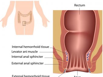 Hemorrhoids-In-Teens——CausesSymptoms-And-Treatment