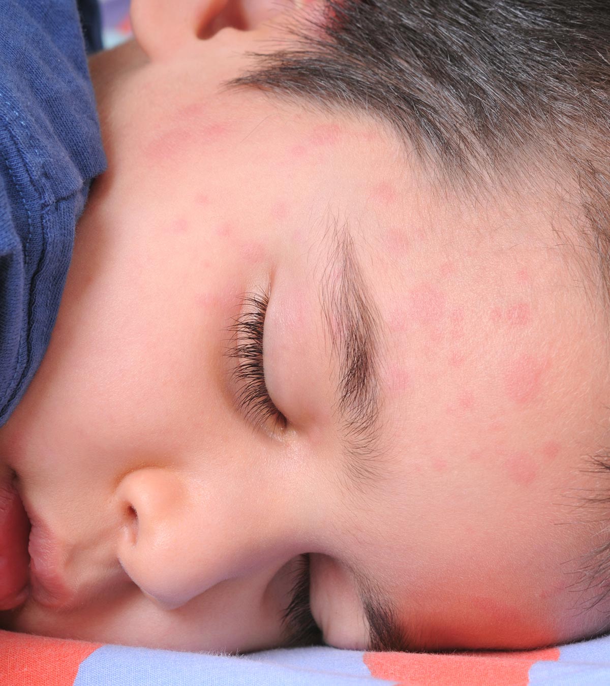 什么是儿童荨麻疹:原因，症状和治疗