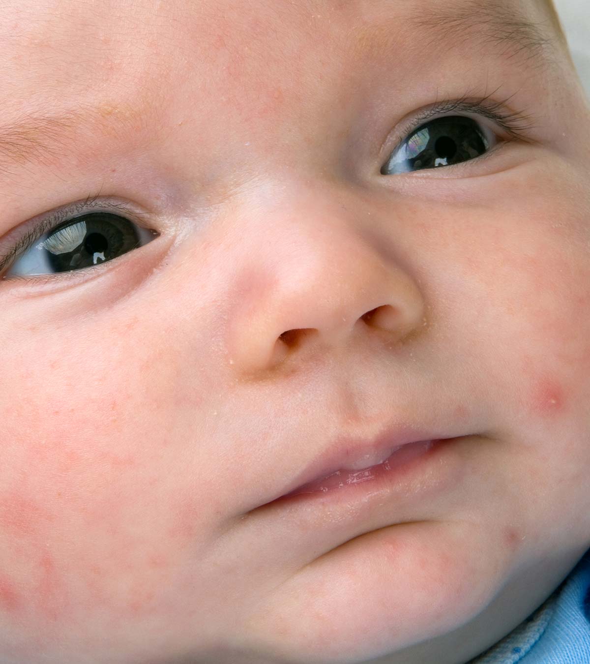 婴儿身上的瘀点:原因、症状、诊断和治疗