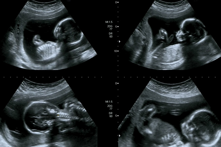 怀孕第三个月时的超声扫描图像