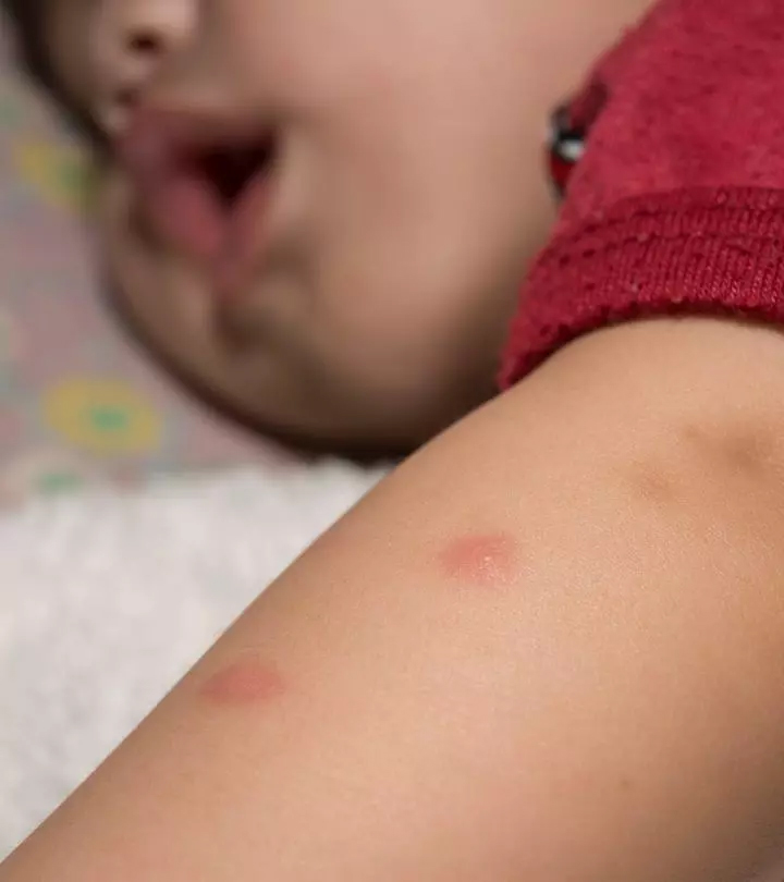 如何治疗和预防婴儿蚊虫叮咬?