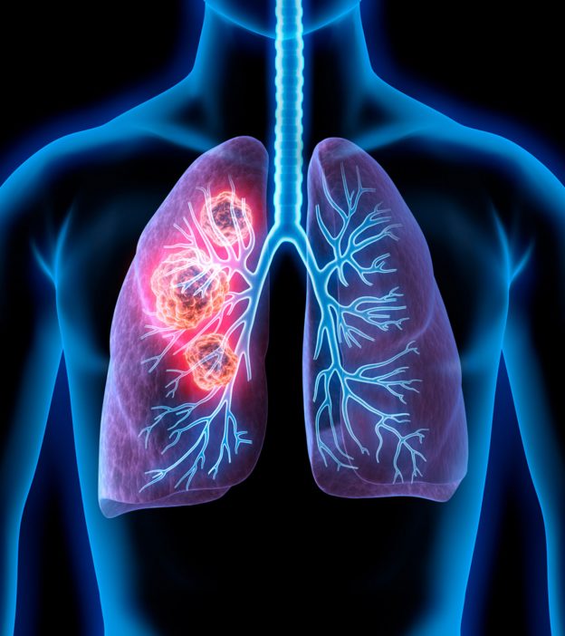 青少年肺癌:体征、病因、治疗和存活率