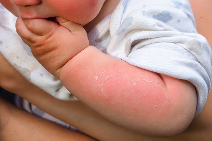 芦荟乳霜被推荐用于缓解轻度晒伤引起的疼痛