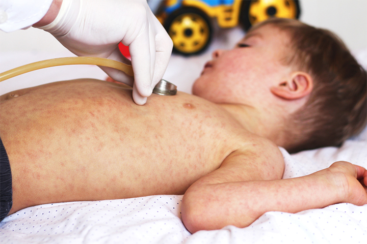 幼儿的红疹开始于胸部和胃部万博体育手机官方网站登录