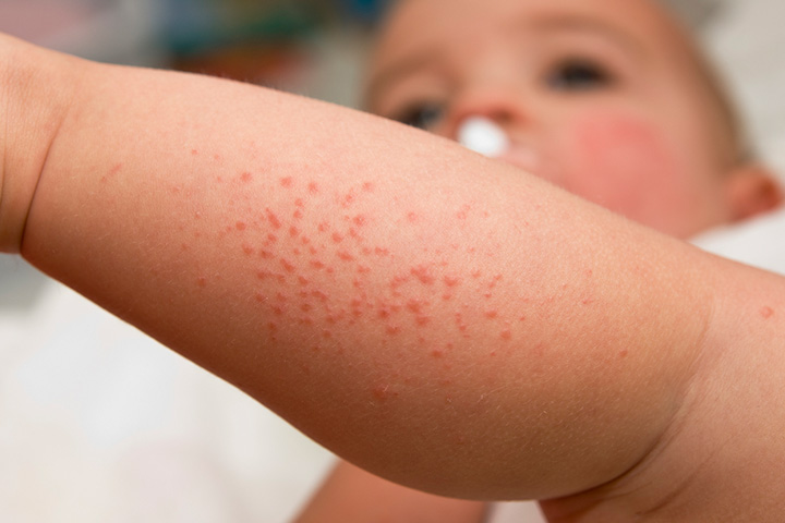 荨麻疹和发红是芦荟过敏的迹象