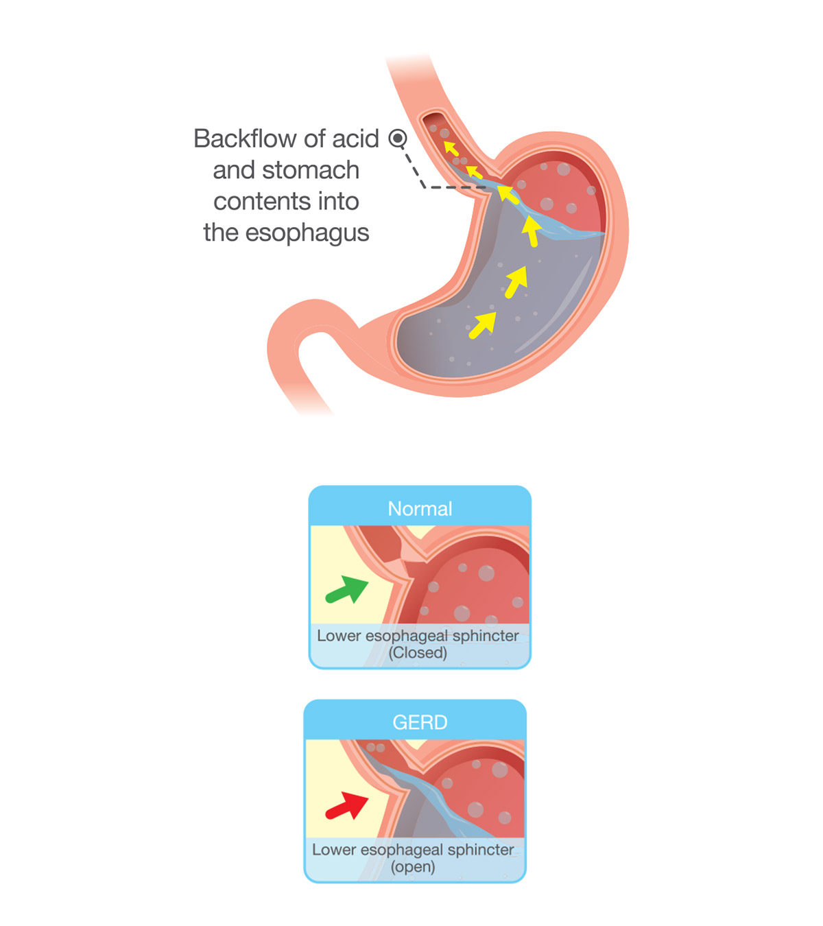 婴儿胃酸反流的11种常见症状及其治疗
