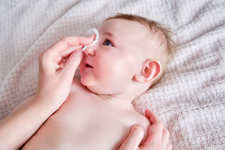 用无菌棉球轻轻地去除宝宝眼睛里的过敏原