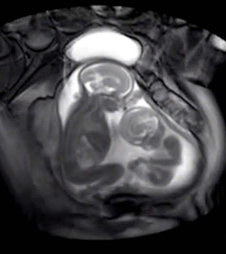这张子宫内双胞胎婴儿的核磁共振扫描正在迅速传播。理由会让你大吃一惊