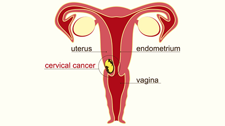怀孕期间的子宫颈癌-你需要知道的manbet安卓版一切