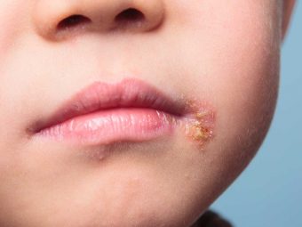 儿童唇疱疹的病因、症状和治疗
