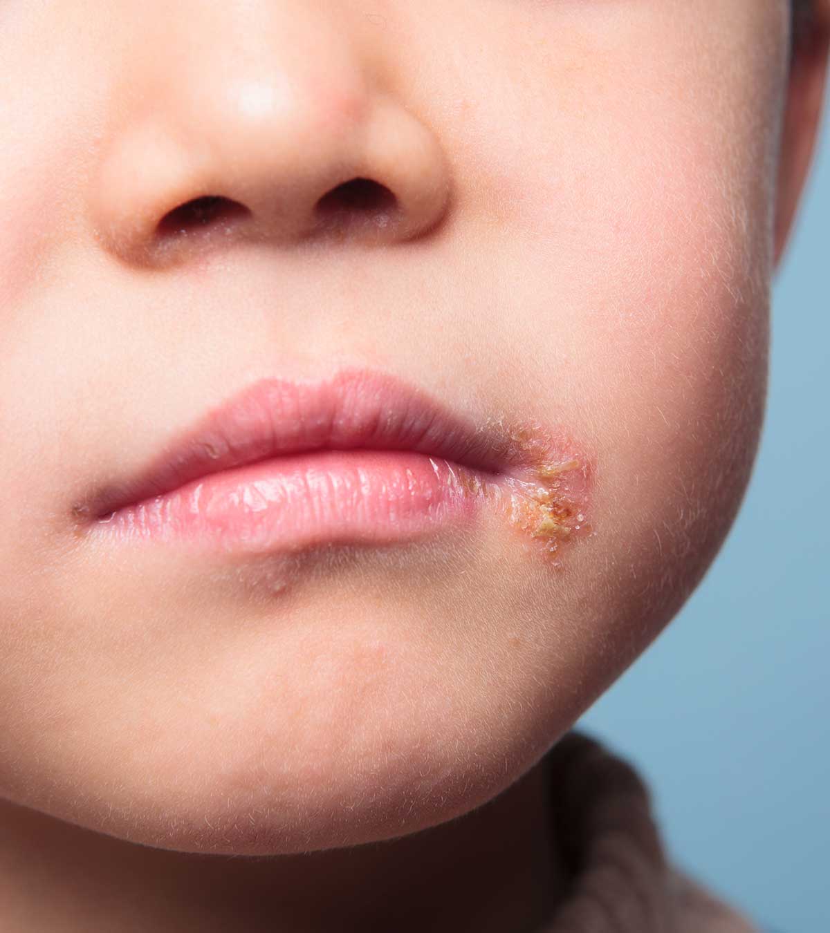儿童唇疱疹(发热水泡):原因和治疗