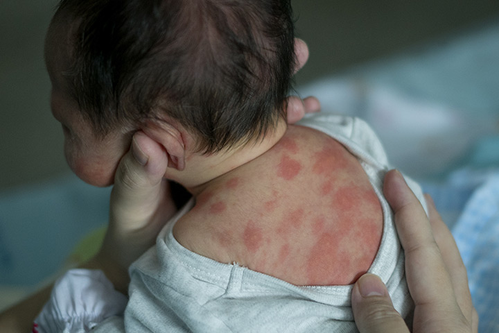 毒性红斑引起的婴儿皮疹
