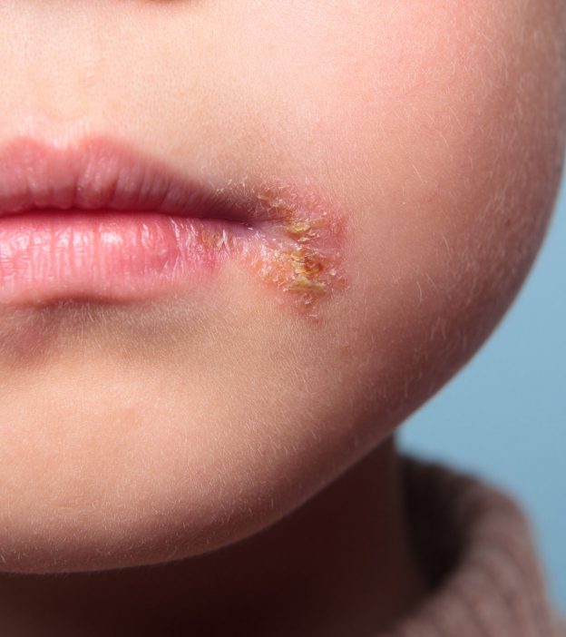 儿童脓疱疮:症状、治疗和预防