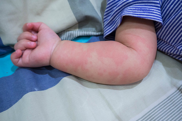 婴儿因皮肤荨麻疹而出现皮疹