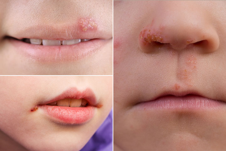 The appearance of cold sores in children