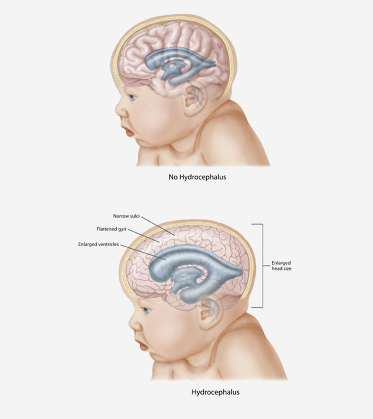 婴儿脑积水:原因、症状和治疗