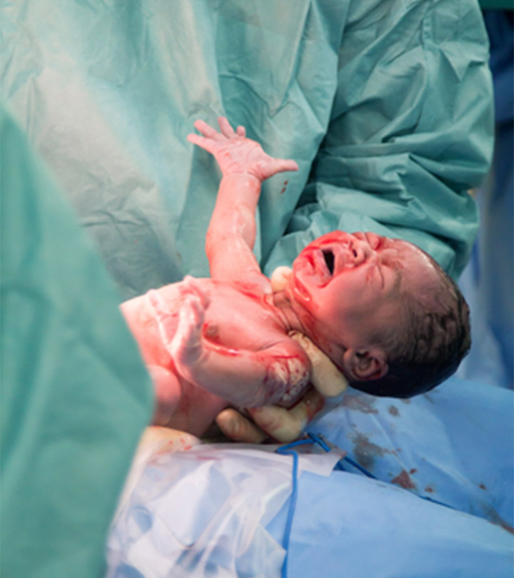 剖腹产对新生儿的影响
