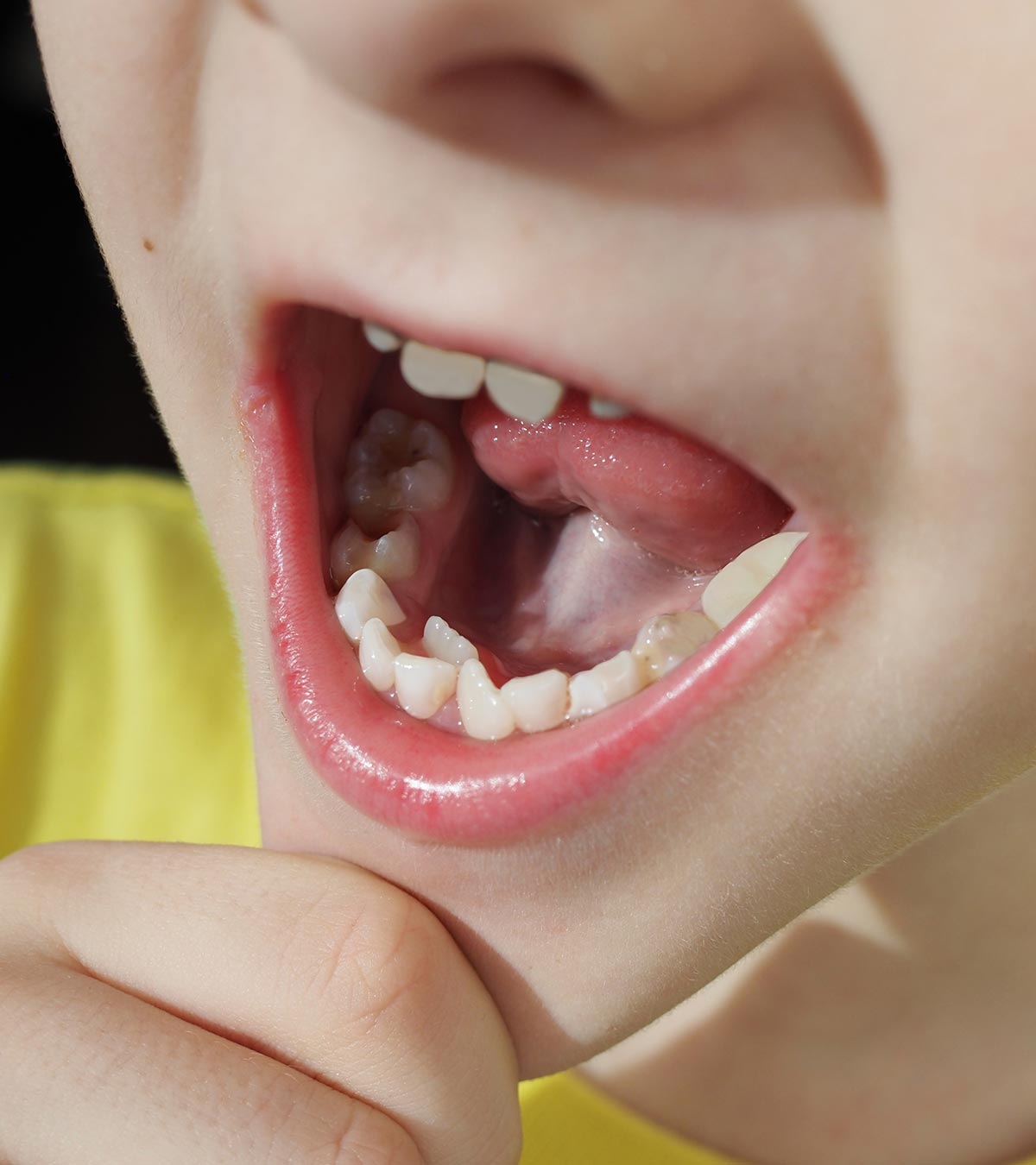 儿童多牙症的6个原因及治疗方法