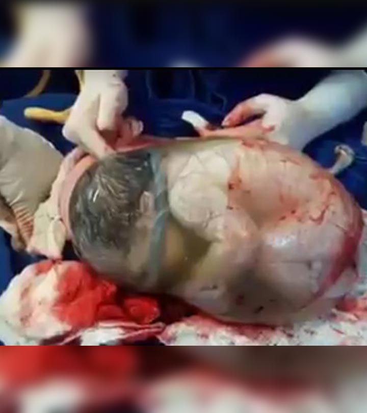 罕见的视频显示一个婴儿在羊膜囊中出生